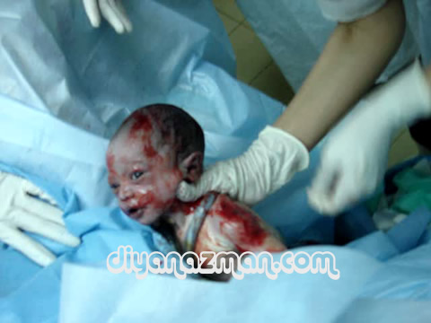 Baby during child birth